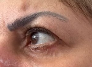 Eyelid lift for Eyelid bags (3) Eyelid wrinkles and Fat Bags and Drooping Upper Eyelid treated by Eyelid Lift blepharoplasty at Best Cosmetic Surgery Egypt
