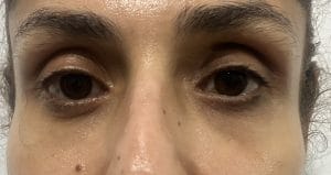 Transconjunctival Blepharoplasty Eyelid lift (1) Bags in the lower eyelid treated by Transconjunctival Lower eyelid Blepharoplasty and Eyelid Lift at Best Cosmetic Surgery in Egypt