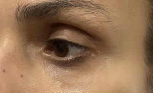 Transconjunctival Blepharoplasty Eyelid lift (2) Bags in the lower eyelid treated by eyelid Blepharoplasty and Eyelid Lift at Best Plastic Surgery in Egypt