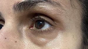 Transconjunctival Blepharoplasty Eyelid lift (3) Bags in the lower eyelid treated by Transconjunctival Lower eyelid Blepharoplasty and Eyelid Lift at Best Aesthetic Surgery in Egypt