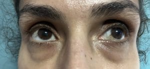 Transconjunctival Blepharoplasty Eyelid lift (4) Bags in the lower eyelid treated by Transconjunctival Lower eyelid Blepharoplasty and Eyelid Lift at Best Plastic Surgery in Egypt