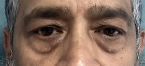 Eyelid Lift (2) Tear trough Deformity and Baggy eyelids treated by Upper and Lower Eyelid Lift at Best Plastic Surgery