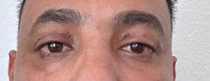 Eyelid Folds (1) Upper Eyelid Folds and double eyelid for upper blepharoplasty and Eyelid lift at best Cosmetic Surgery