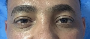 Eyelid Folds (2) Upper Eyelid Folds and double eyelid for upper blepharoplasty and Eyelid lift at best Plastic Surgery