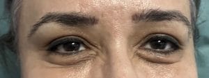 Lower eyelid Lift Eyelid bags and tear trough deformity and Eyelid Lift blepharoplasty at Best Plastic Surgery Egypt