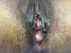 Wide patulous vagina and enlarged Labia treated by Labiaplasty and Vaginoplasty and Vulvoplasty at Best Plastic Surgery egypt