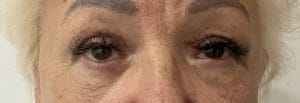 Transconjunctival lower bleph (1) Upper and Lower Eyelid Lift Blepharoplasty for Eyelid Bags at Best Plastic surgery Egypt