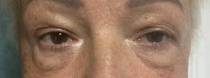 Transconjunctival lower bleph (2) Upper and Lower Eyelid Lift Blepharoplasty for Eyelid Bags at Best Cosmetic surgery Egypt