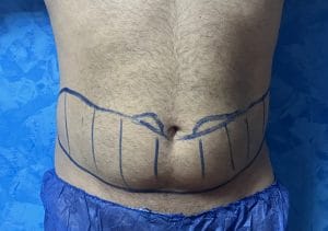 Vaser Smart Liposuction for stubborn Belly fat and Waist Bulge at best Plastic Surgery Egypt