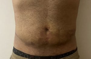 Vaser Smart Liposuction for stubborn Belly fat and Waist Bulge at best Cosmetic Surgery Egypt