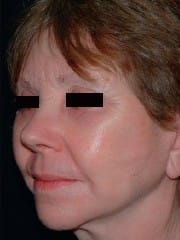 face smas – Copy (2) Sagging face and Jowls and eyelid wrinkles for deep Facelift and Neck liposuction and Blepharoplasty at Best Plastic Surgery Egypt
