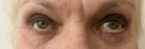 Blephroplasty Eyelids (1) Recurrent eyelid Wrinkles and Bags and swelling oafter previous Blepharoplasty at Cosmetic Surgery Clinic