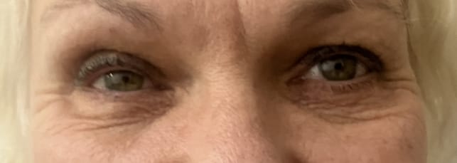 Blephroplasty Eyelids (2) Recurrent eyelid Wrinkles and Bags and swelling oafter previous Blepharoplasty at Plastic Surgery Clinic