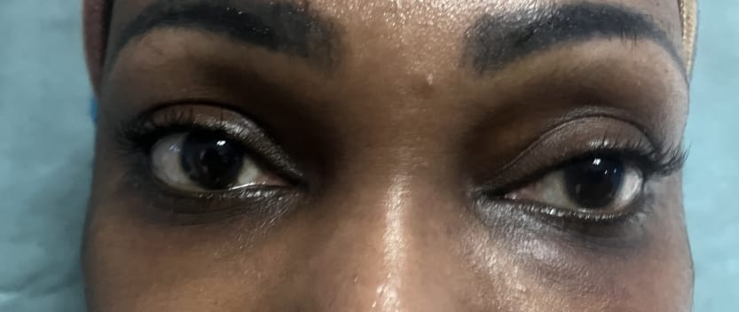 Eyelid Lift Transconjunctival blepharoplasty (1) Dark halos and Eyelid Bags treated by Lower Eyelid Lift Blepharoplasty at Best Plastic Surgery Egypt