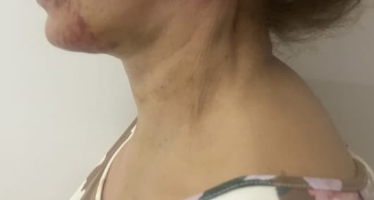 Neck Lift Liposuction (2) Neck Lift and Liposuction and Muscle bands and Jawline at best Cosmetic Surgery Egypt