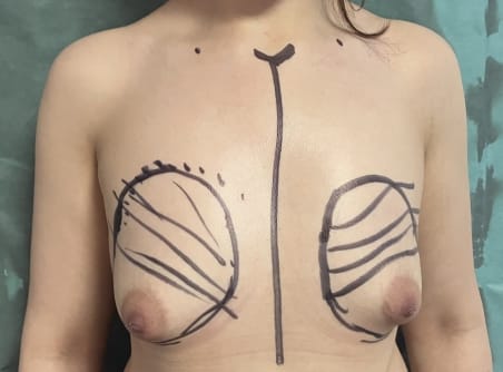 Breast enlargement and Augmentation by silicon Implants at Best Cosmetic Surgery Egypt