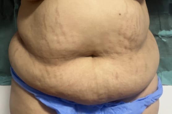 Tummy Liposuction (2) Abdominal Tummy Liposuction using Vaser Liposuction at Best Plastic surgery Egypt