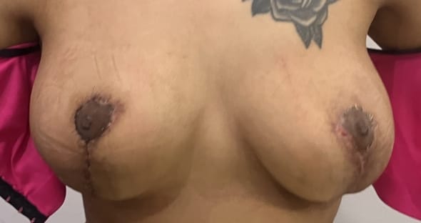 Breast Implant replacement by Breast Explant and Breast Lift after Breast Augmentation at Best Cosmetic Surgery Egypt