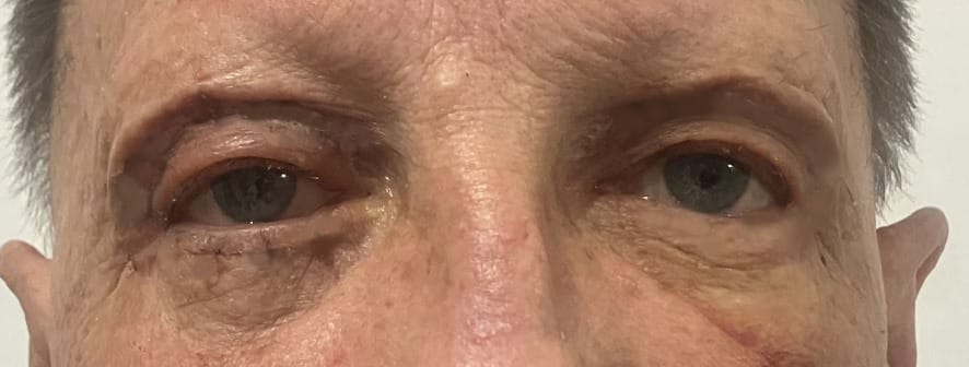 Eyelid-Lift-blepharoplasty- Eyelid Wrinkles and Bags of Fat and lax muscles for Upper and Lower Eyelid Blepharoplasty at Best Cosmetic Surgery Egypt