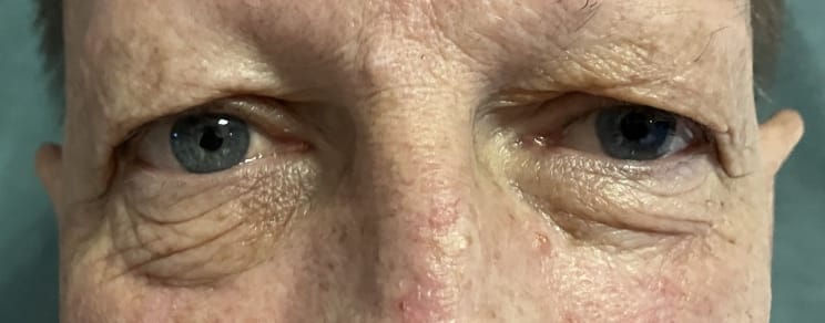 Eyelid Lift blepharoplasty (2) Eyelid Wrinkles and Bags of Fat and lax muscles for Upper and Lower Eyelid Blepharoplasty at Best Plastic Surgery Egypt