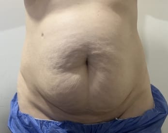 Bulging Tummy and loss of waist for Tummy Tuck and Waist Liposculpture and Muscle strengthening at Best Plastic Surgery Egypt