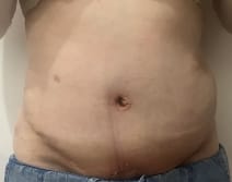 Bulging Tummy and loss of waist for Tummy Tuck and Waist Liposculpture and Muscle strengthening at Best Cosmetic Surgery Egypt