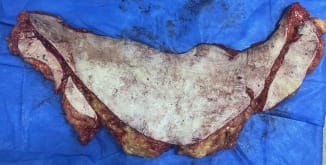 Bulging Tummy and loss of waist for Tummy Tuck and Waist Liposculpture and Muscle strengthening at Best Aesthetic Surgery Egypt