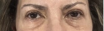 Tear Trough Deformity and Puffy Eyelids treated by Eyelid Lift blepharoplasty at Best Plastic Surgery Egypt