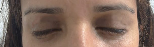 Blepharoplasty wrinkles Eyelid Wrinkles and Minimal eyelid bags treated by Skin Eyelid Lift at Best Cosmetic Surgery Egypt