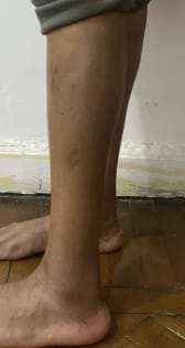 Thin legs and Slim calf treated by Fat Grafting and Calf Enhancement at Best Cosmetic Surgery Egypt