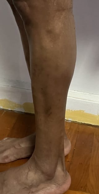 Thin legs and Slim calf treated by Fat Grafting and Calf Enhancement at Best Plastic Surgery Egypt