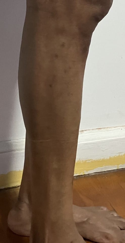 Thin legs and Slim calf treated by Fat Grafting and Calf Enhancement at Best Aesthetic Surgery Egypt