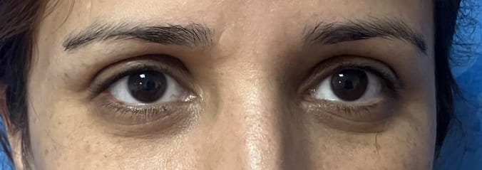 Eyelid Wrinkles (2) Eyelid Wrinkles and Minimal eyelid bags treated by Skin Eyelid Lift at Best Plastic Surgery Egypt