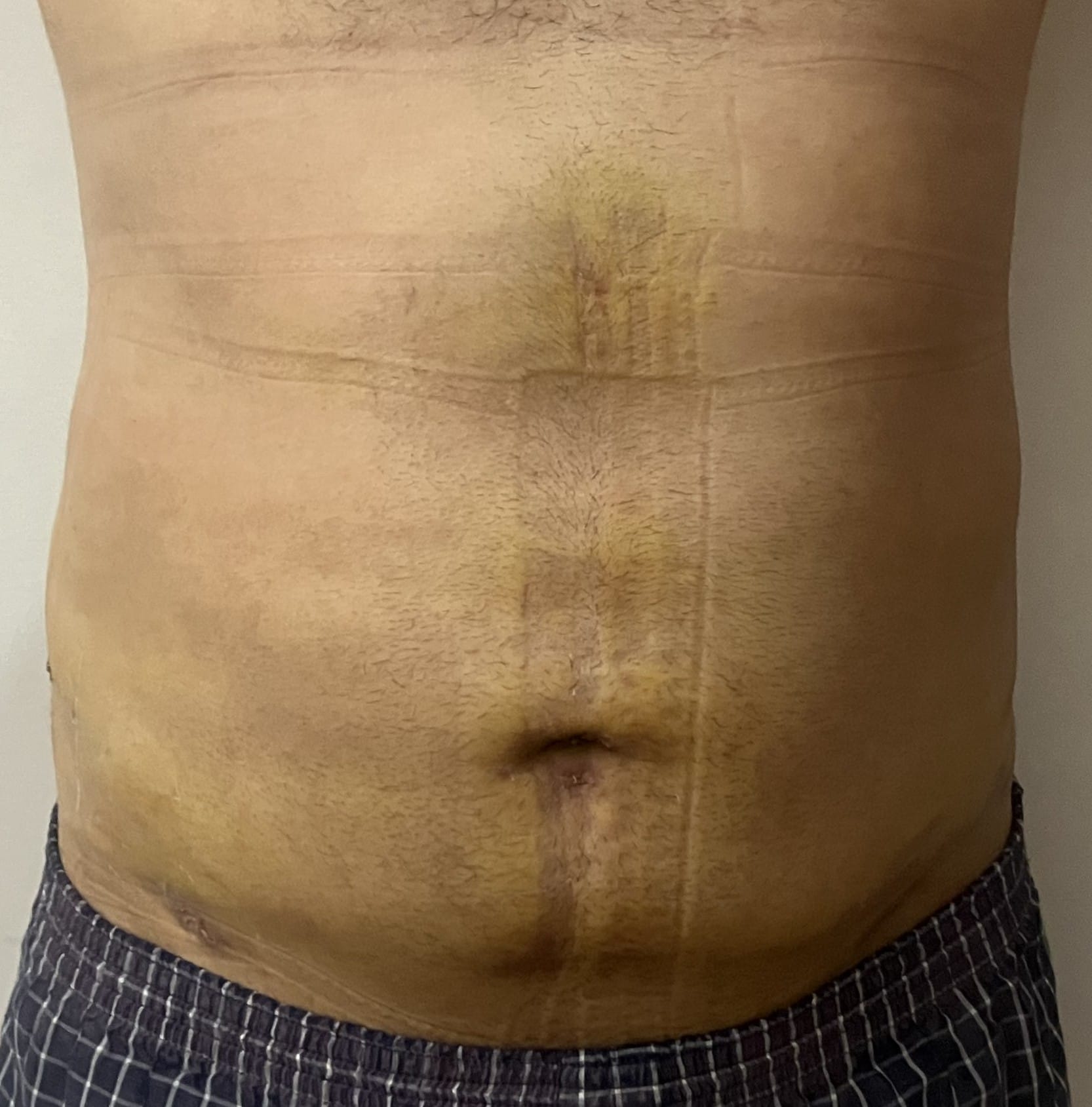 Bulging Tummy and waist treated by smart High definition Vaser Liposuction and 6-pack creation at Best Cosmetic Surgery