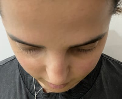 Triangular Face with asymmetric Cheek Bones before Fat Grafting