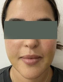 Fat Grafting to Enhance thin tapering face with asymmetry at Best Cosmetic Surgery Egypt