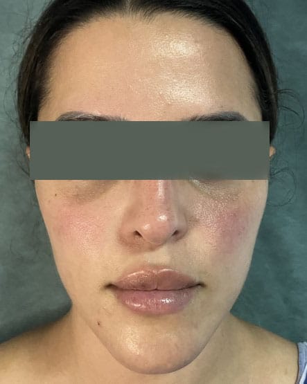 Fat Grafting to Enhance thin tapering face with asymmetry at Best Plastic Surgery Egypt