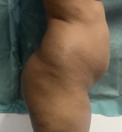 Hip Dips Fat filler (1) Fat Grafting at Best Plastic Surgery Egypt to fill Hip Dips with Tummy Liposuction Fats