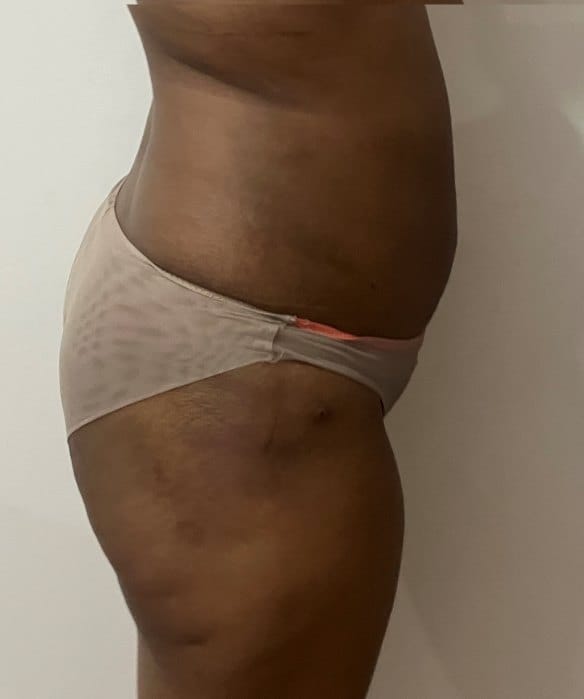 Hip Dips Fat filler (2) Fat Grafting at Best Cosmetic Surgery Egypt to fill Hip Dips with Tummy Liposuction Fats