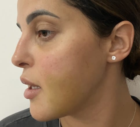 Full Cheeks and aesthetically pleasing Jowls after nano fat grafting