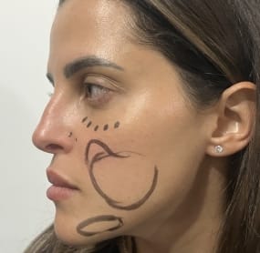 Tear Trough, Hollow cheek and empty jowls before fat Injection at Best Plastic Surgery egypt