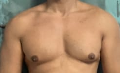 Enlarged Pectoral muscles and Male chest Gynecomastia treated by gland Excision and Liposuction at Best Plastic Surgery Egypt