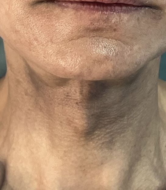 Neck lift (1) Residual Platyzmal Bands after a previous Neck lift treated by Neck Liposuction at Best Plastic Surgery Egypt