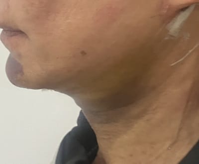 Neck lift (2) Residual Platyzmal Bands after a previous Neck lift treated by Neck Liposuction at Best Cosmetic Surgery Egypt