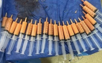 Sagging Thighs and Flat Butts treated by Fat Transfer to get Brazilian Butt Lift and Thigh Liposuction at Best Aesthetic Surgery