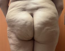 Butt Lift and Thigh Lift (2) Cellulite Treatment and Butt Lift by fat Transfer after thigh liposuction at Plastic Surgery Egypt