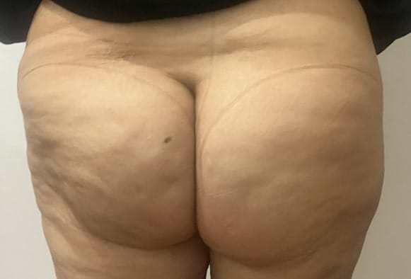 Butt Lift and Thigh Lift (3) Cellulite Treatment and Butt Lift by fat Transfer after thigh liposuction at Cosmetic Surgery Egypt