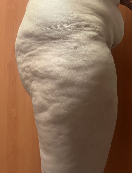 Sagging Thigh and Cellulite treated by Thigh Liposuction and Thigh Lift at Best Cosmetic Surgery Egypt