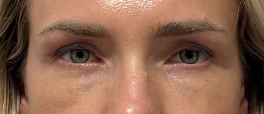 Lower-Eyelid-Bags-(1) Lower Eyelid Bags and Wrinkles treated by Eyelid Blepharoplasty at Best Cosmetic Surgery