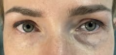 Lower Eyelid Bags (2) Lower Eyelid Bags and Wrinkles treated by Eyelid Blepharoplasty at Best Plastic Surgery